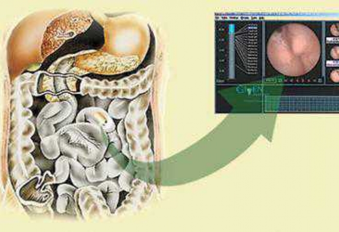Капсульная гастроскопия