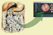 Капсульная гастроскопия
